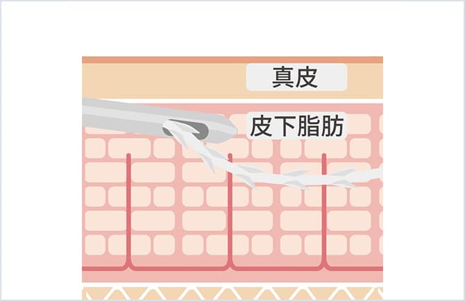 真皮と皮下脂肪に対する糸