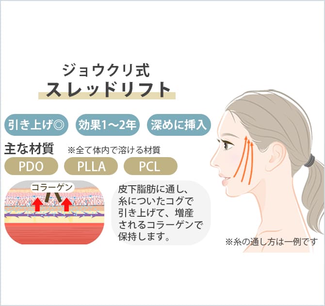 リフトアップスレッドの図
