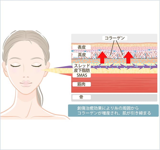 スレッドリフトの効果とお肌の断面図