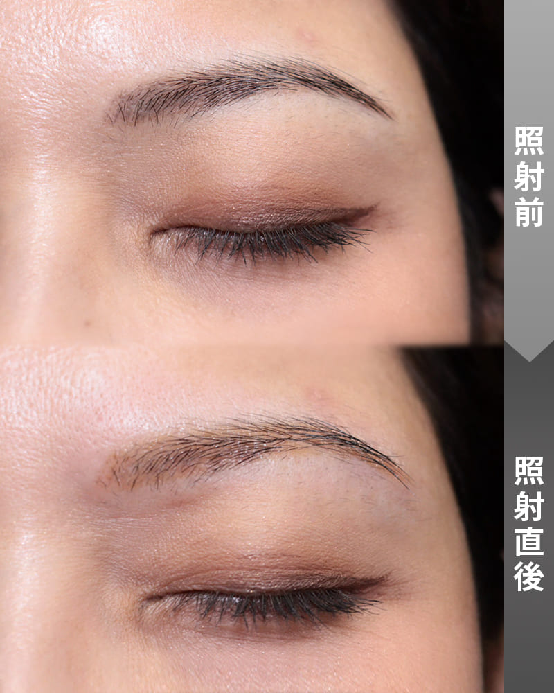 韓国で主流のレイヤー法を取り入れたアートメイク除去