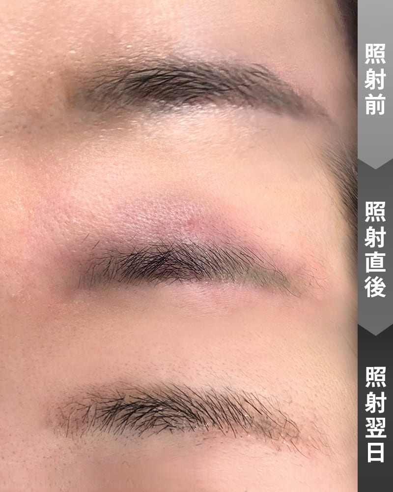 痛み・出血のリスクを大幅軽減