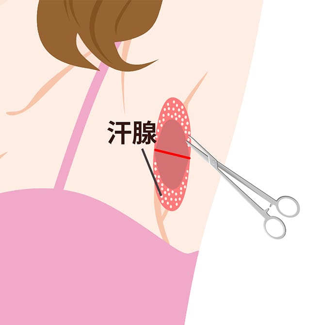 ワキガ手術（皮弁法・剪除法） | 美容整形外科のジョウクリニック