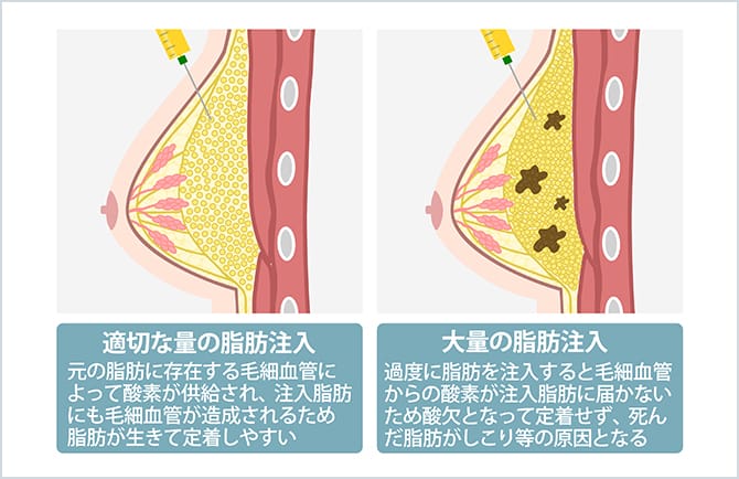 適切な量の脂肪注入と大量の脂肪注入の比較