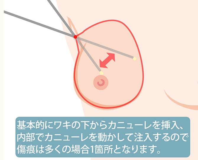 ワキの下からカニューレを挿入