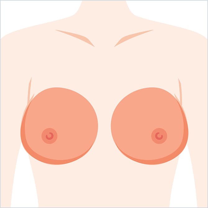 胸の脂肪注入の位置