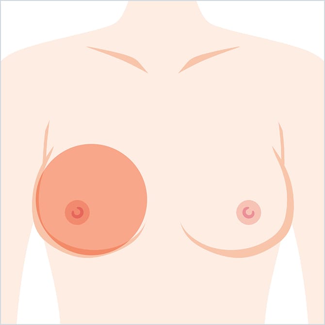 胸の脂肪注入の位置