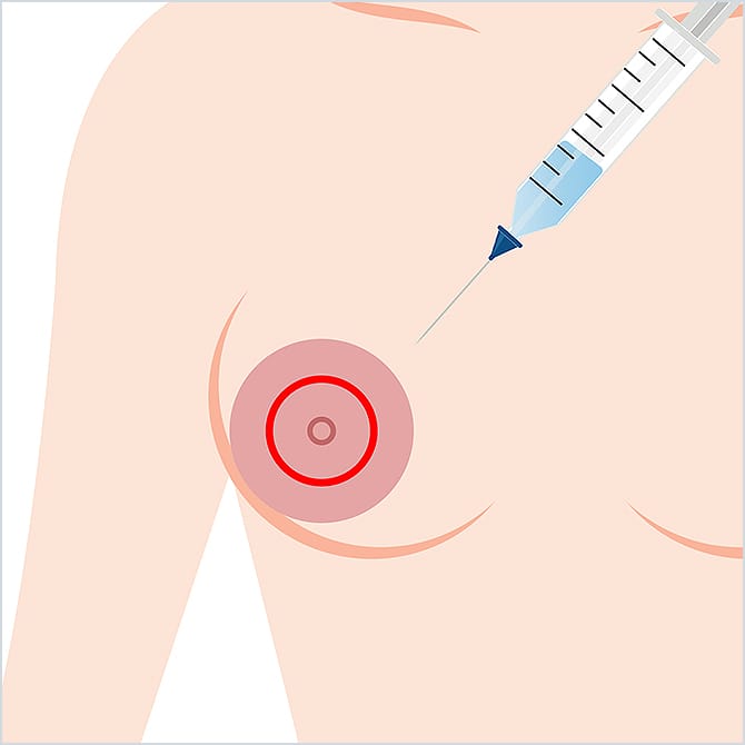 乳輪にマーキングするイラスト