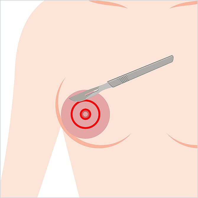 乳輪の周りを切開するイラスト