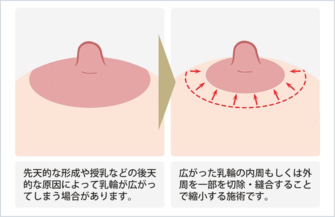 乳輪 プルージュ美容クリニック・乳輪・乳頭縮小術 |東京 品川の美容 ...