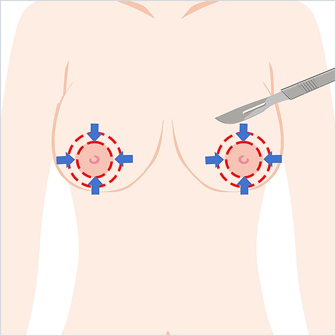 乳輪の周りを切開するイラスト