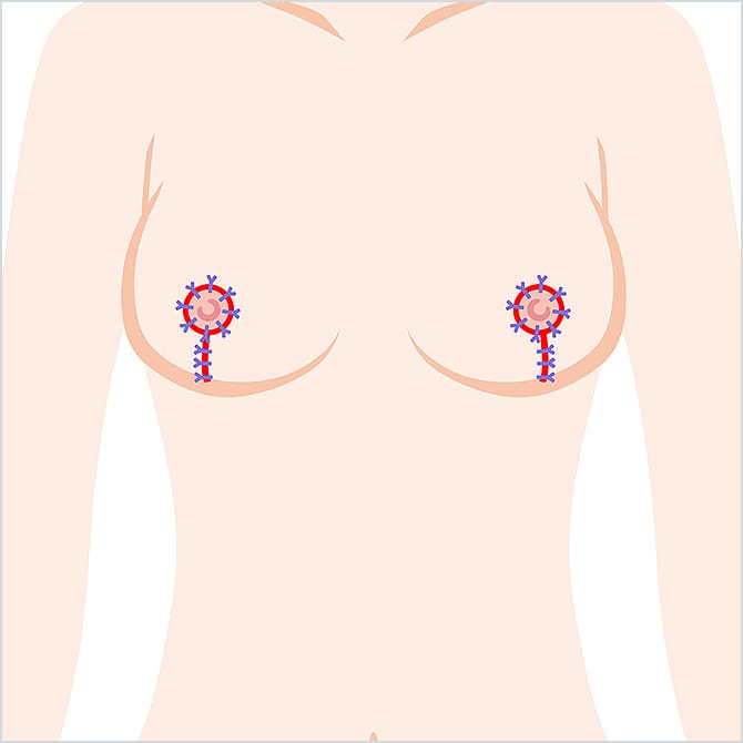 胸の皮膚を縫合するイラスト
