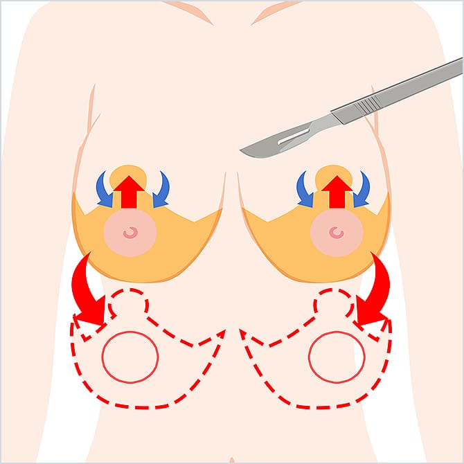 胸の皮膚を錨型に切除するイラスト