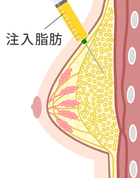 脂肪注入豊胸