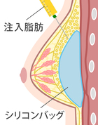 ミアフェムテック＋脂肪注入豊胸）