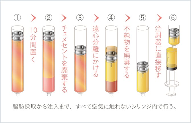 脂肪採取から注入まで、すべて空気に触れないシリンジ内で行う図