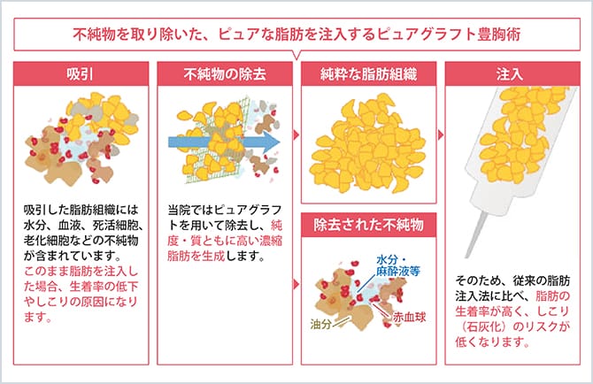 不純物を取り除いた、ピュアな脂肪を注入するピュアグラフト豊胸手術の図