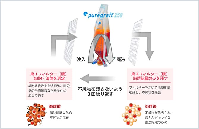 ピュアグラフトによる脂肪加工の手順の図
