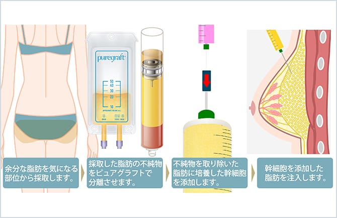 脂肪吸引で採脂した脂肪を、胸に注入する図