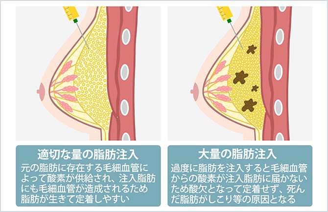 適切な量の脂肪注入と大量の脂肪注入の比較図