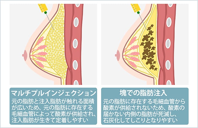 マルチプルインジェクションと塊での脂肪注入の比較図