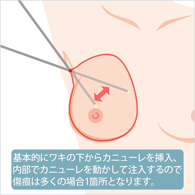 ワキの下からカニューレを挿入して脂肪を注入する図