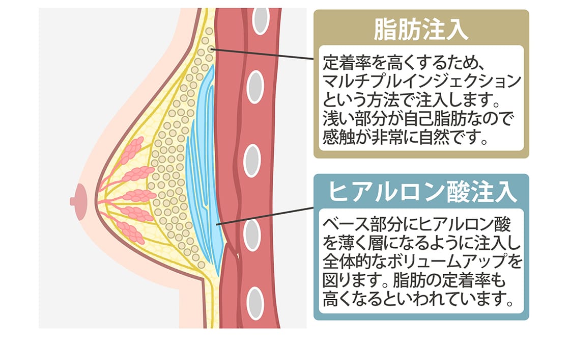 脂肪注入とヒアルロン酸注入のコンビネーション豊胸の図