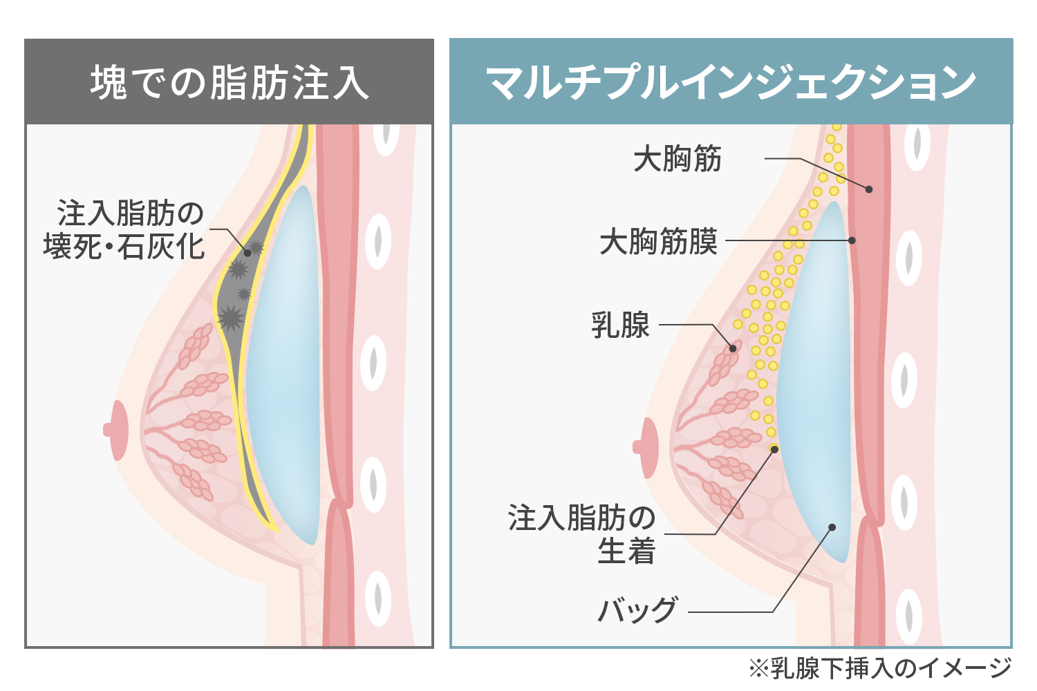 定着率を高めるマルチプルインジェクション