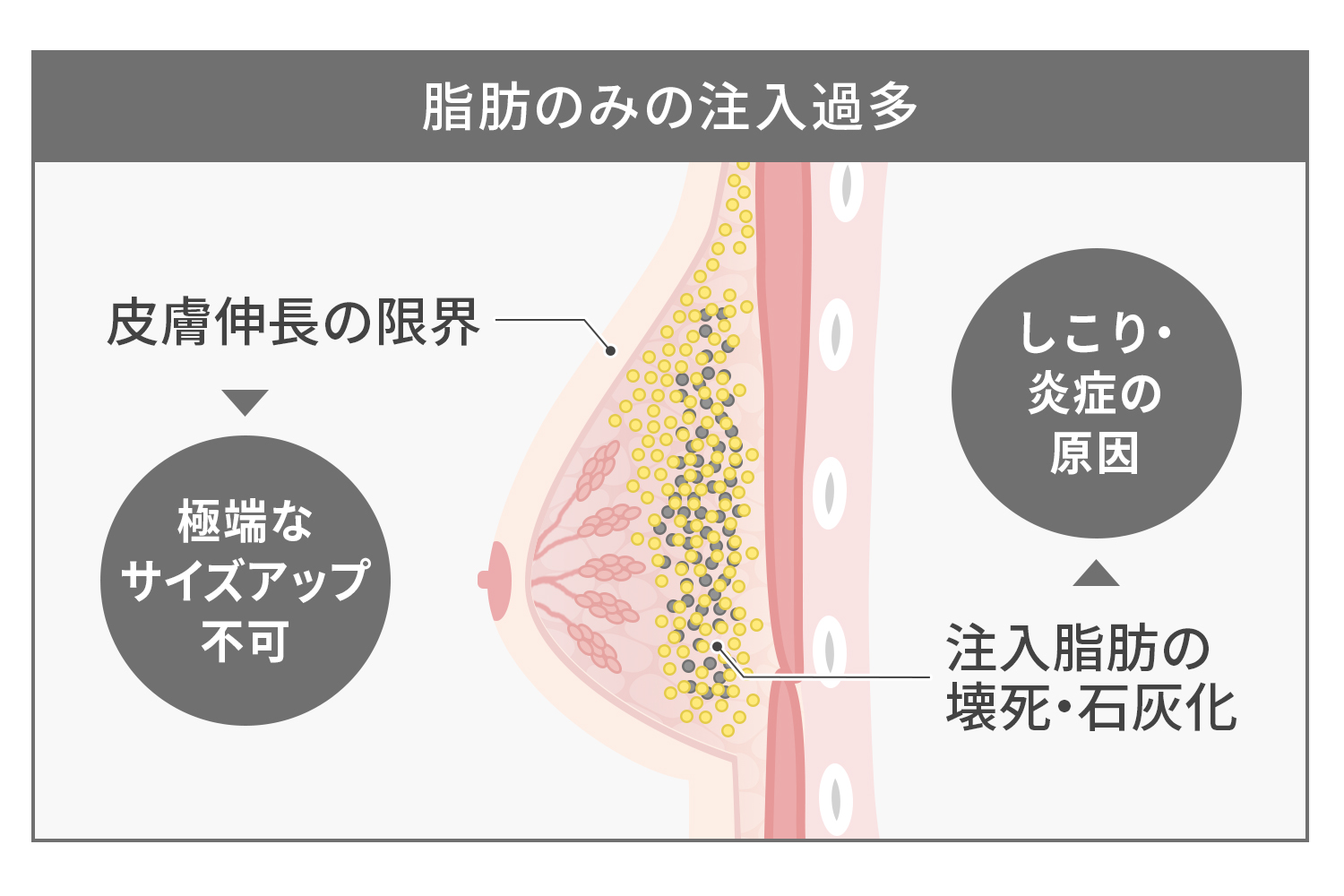 脂肪のみでのサイズアップの限界
