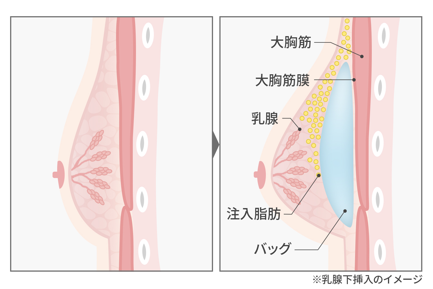 感触とボリュームを両立させる「ハイブリッド豊胸」