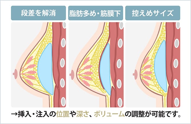 ハイブリッド豊胸での挿入・注入の位置や深さ、ボリュームの調整