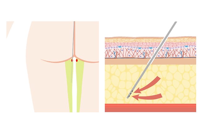 採取部位とカニューレでの脂肪吸引