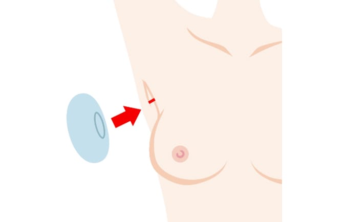 ワキの下からのシリコンバッグ挿入