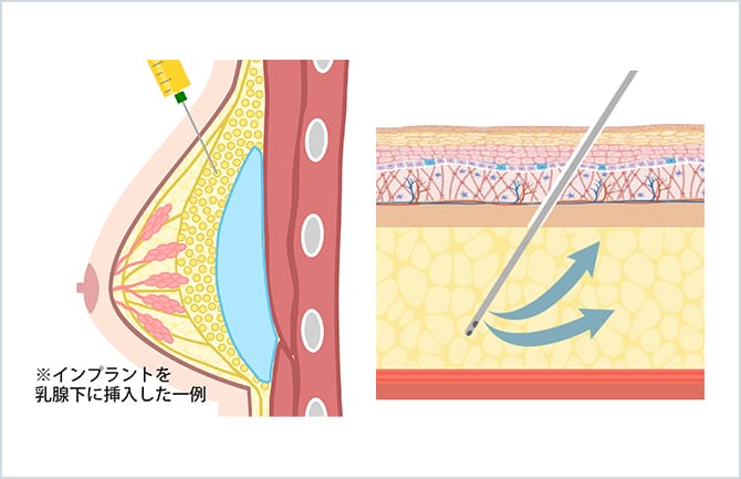 シリコンバッグを乳腺下に挿入した図