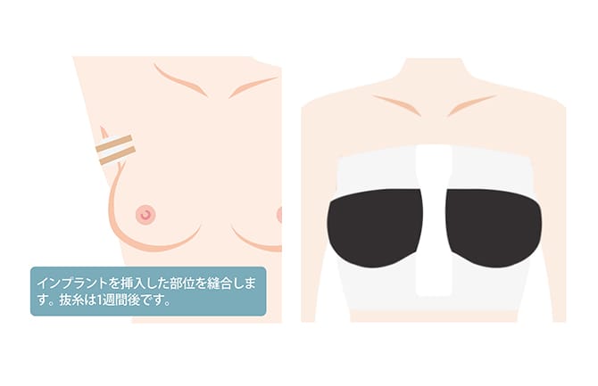 施術後のワキと胸