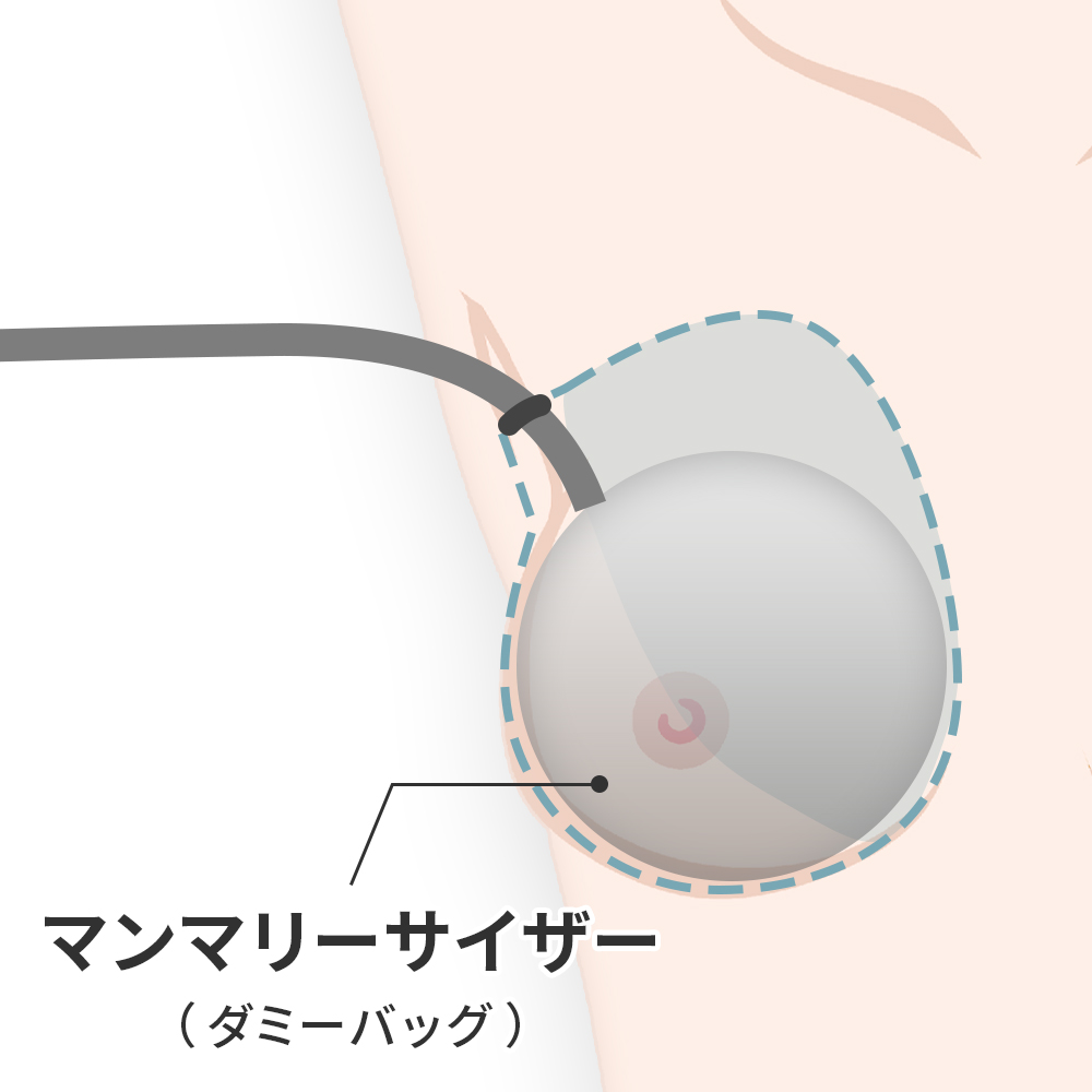 ダミーバッグを挿入する