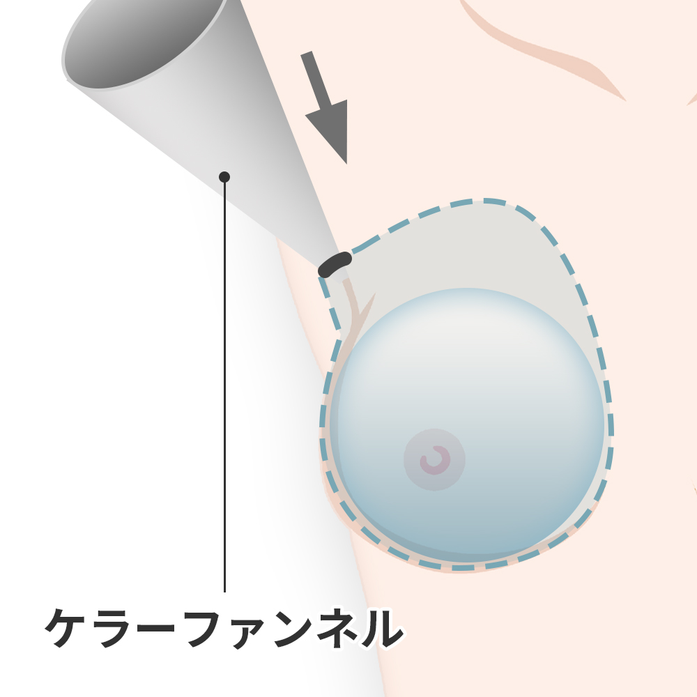 バッグを挿入する