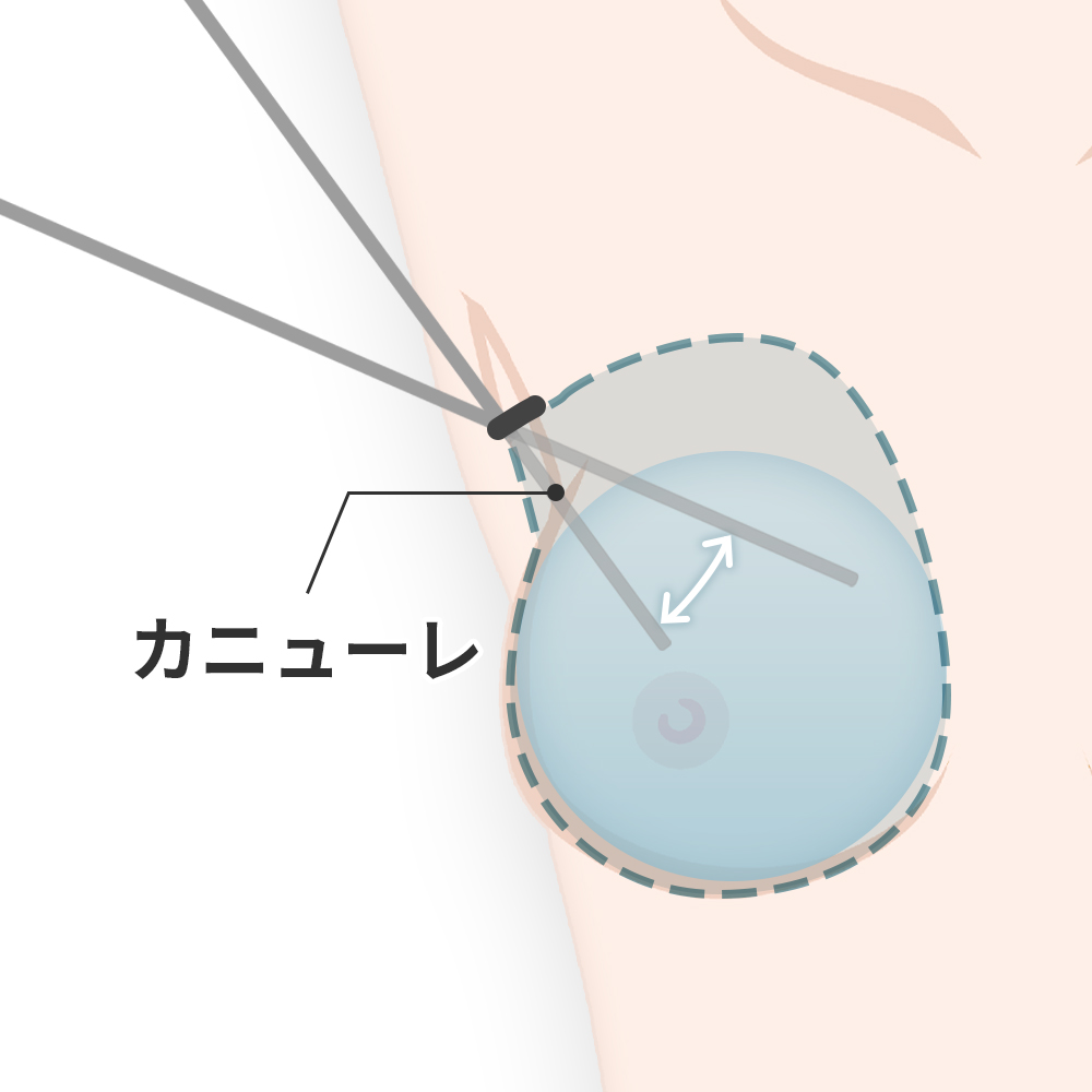 カニューレを挿入