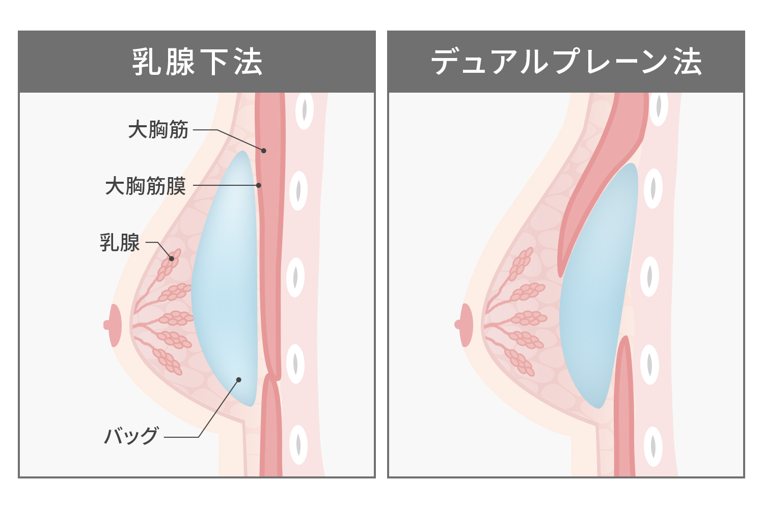 バッグの挿入位置