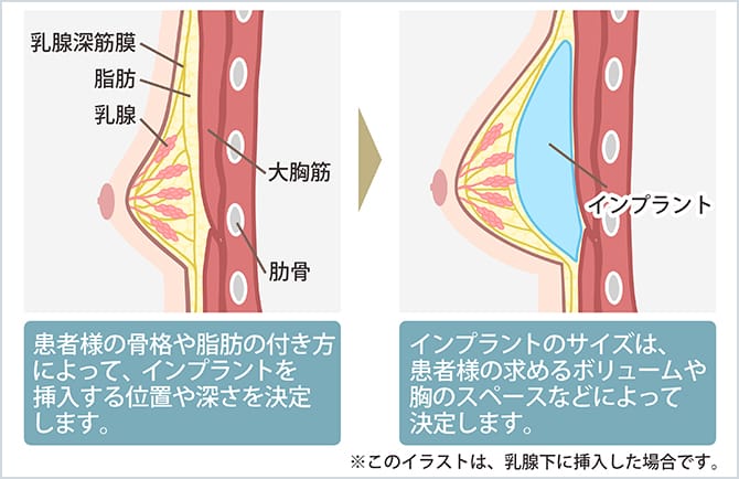 胸の整形メニュー 豊胸 胸の整形ならジョウクリニック