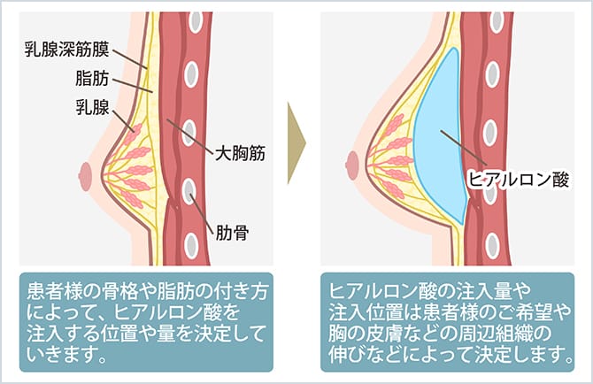 ヒアルロン酸注入豊胸の施術イメージ