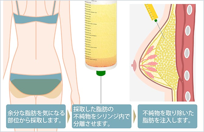 脂肪幹細胞注入豊胸の施術イメージ