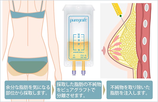 ピュアグラフト豊胸の施術イメージ