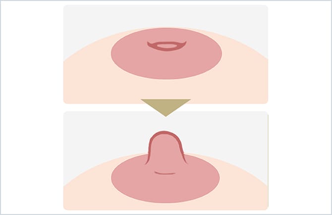 陥没乳頭形成術のイラスト