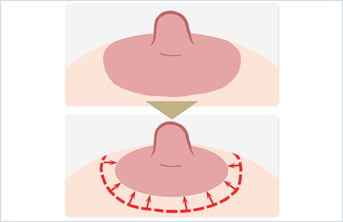 乳輪縮小術のイラスト