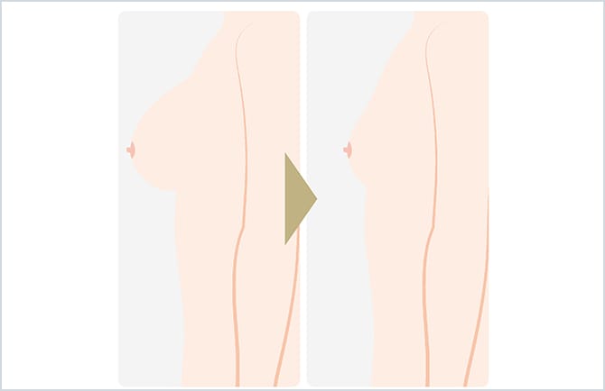 乳房縮小術のイラスト