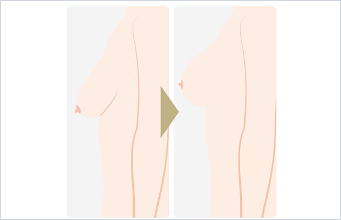 乳房吊上術のイラスト