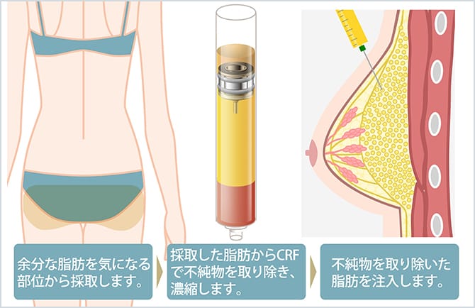 CRF豊胸の施術イメージ