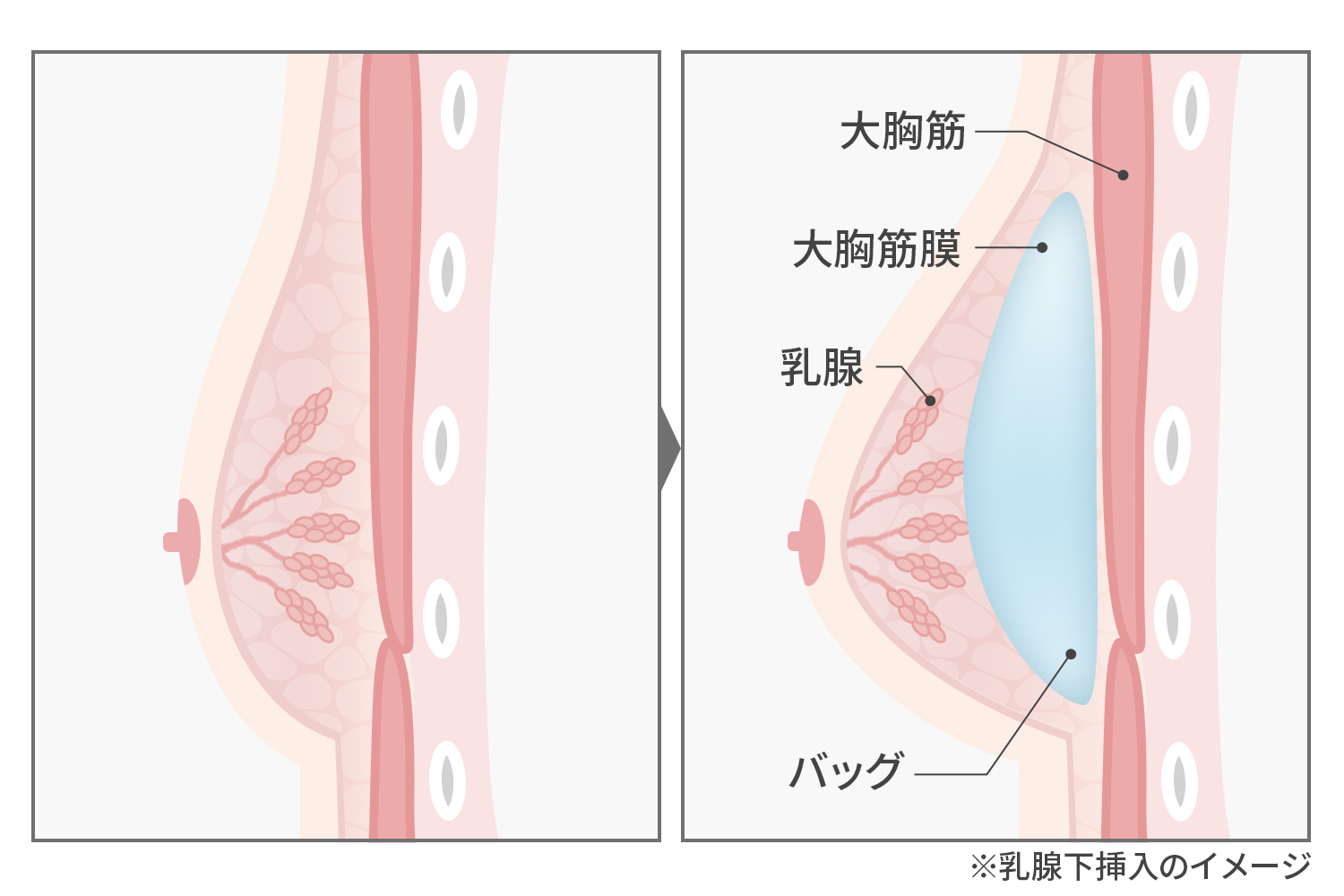 シリコンバッグ豊胸