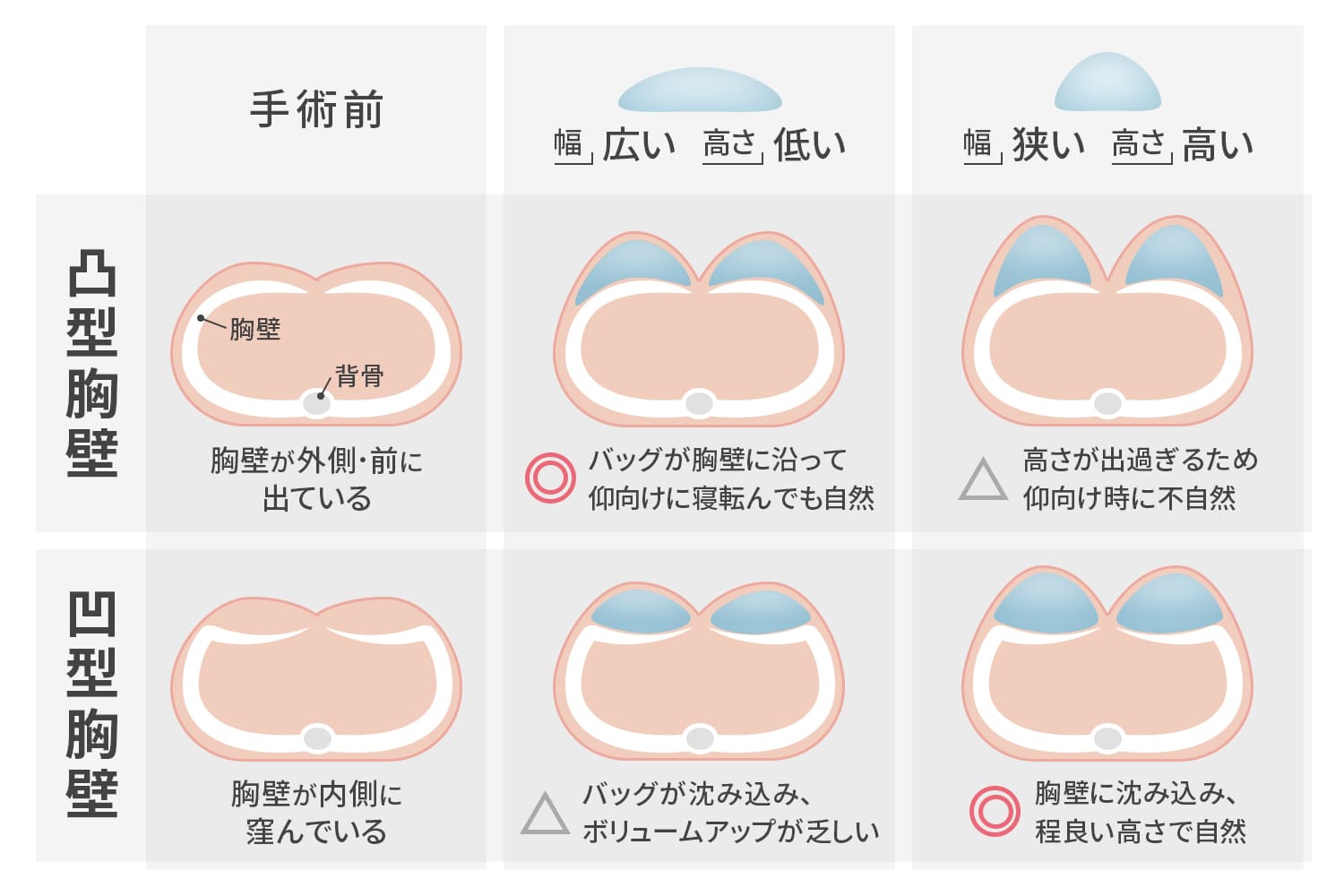 凸型胸壁と凹型胸壁の比較