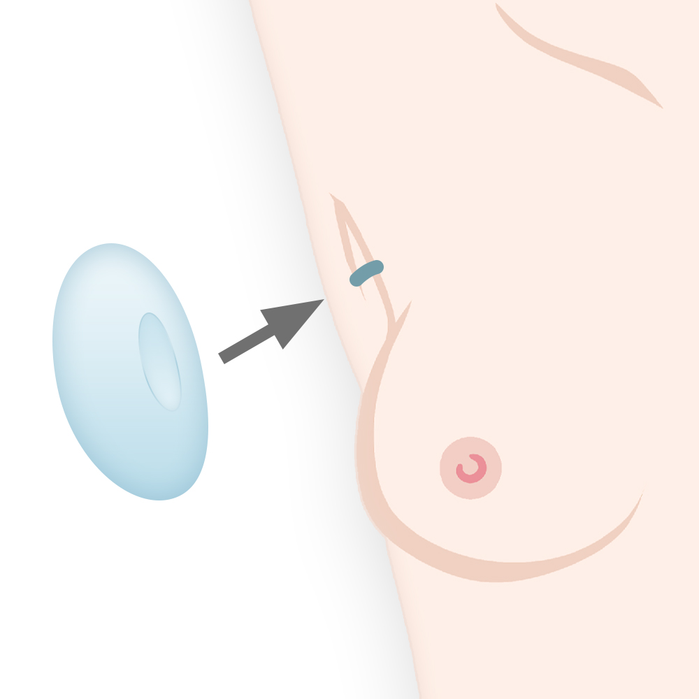 ワキの下を切開